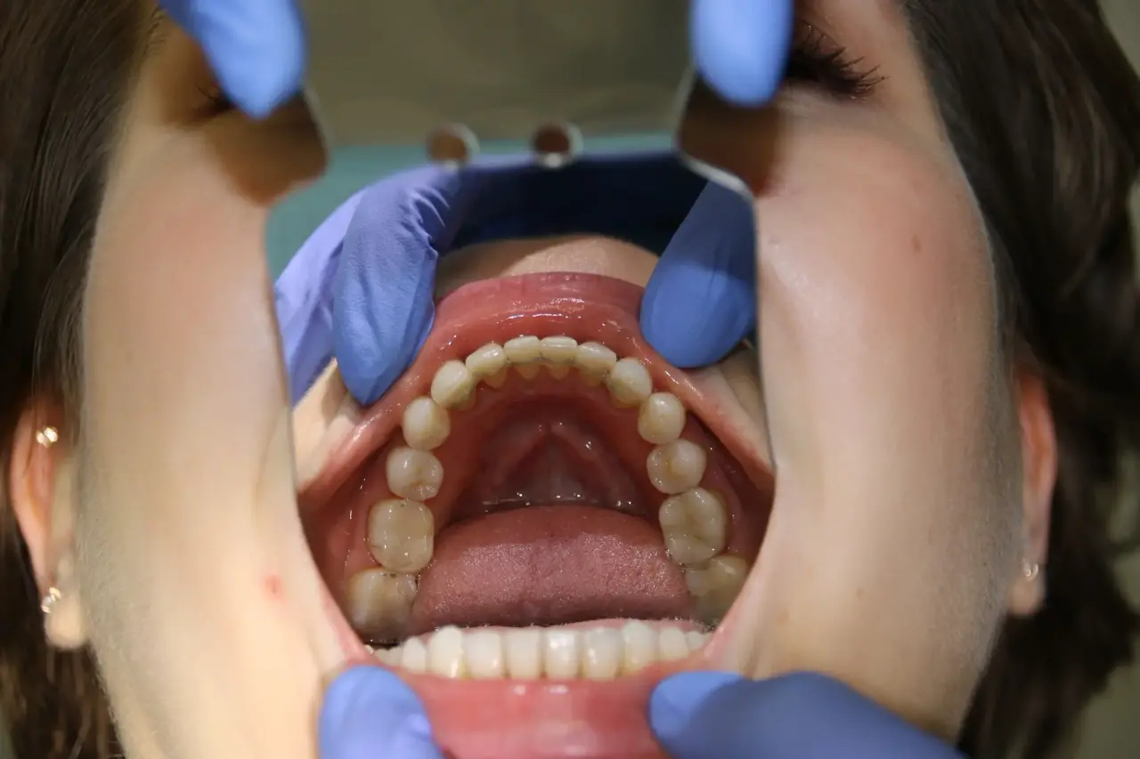 несъемные аппараты