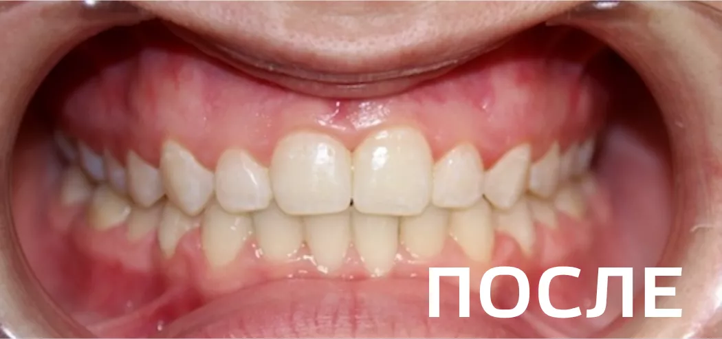Фото после - Исправление прикуса, выравнивание зубов