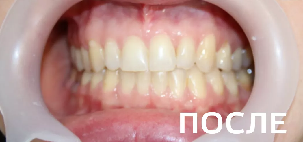 Фото после - Исправление прикуса, выравнивание зубов