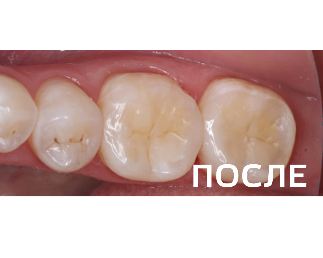 Лечение кариеса 