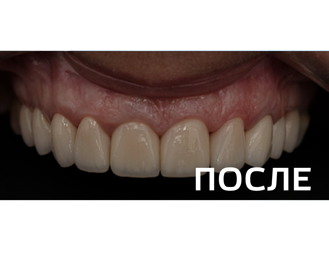 Ортопедическое восстановление фронтальной группы зубов на верхней челюсти керамическими коронками E.max
