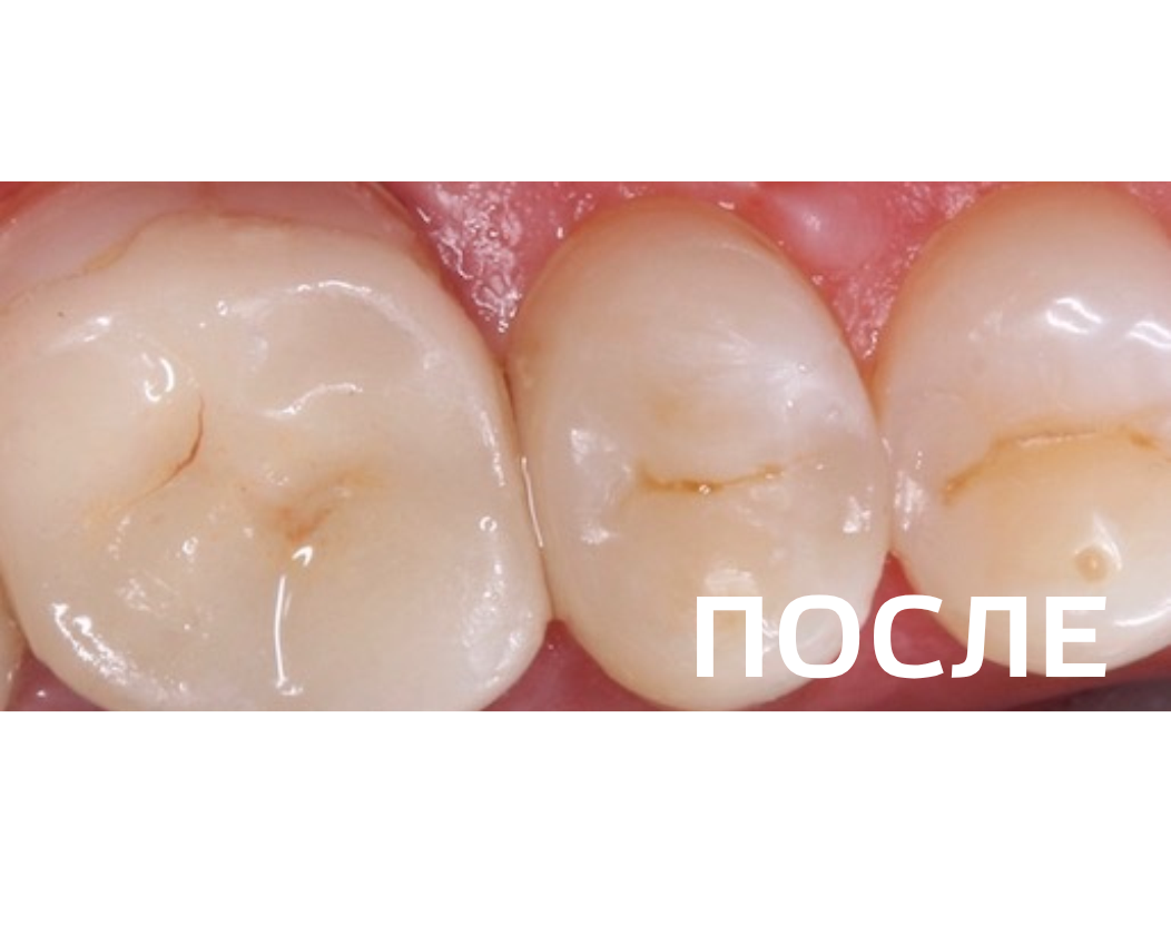 Лечение контактного кариеса