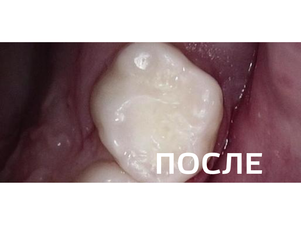 Лечение кариеса