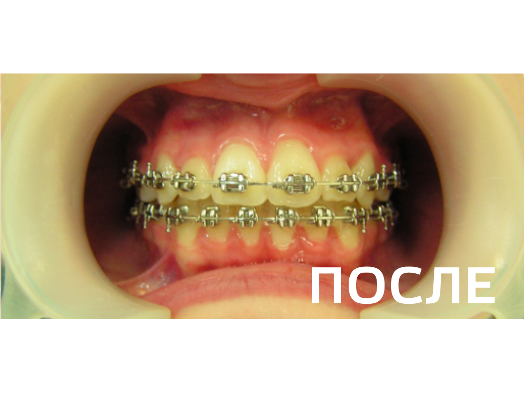 Исправление прикуса, выравнивание зубов
