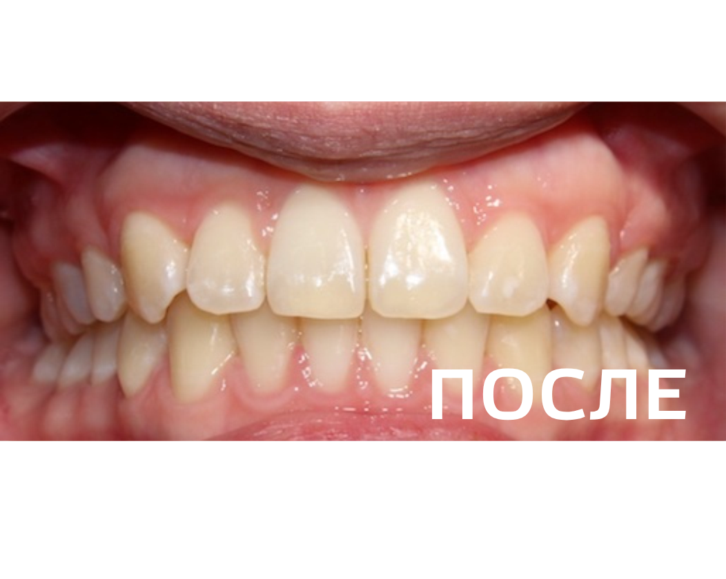 Исправление прикуса, выравнивание зубов