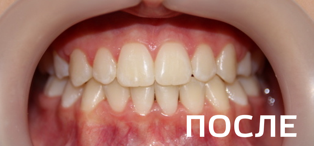 Фото после - Исправление прикуса, выравнивание зубов