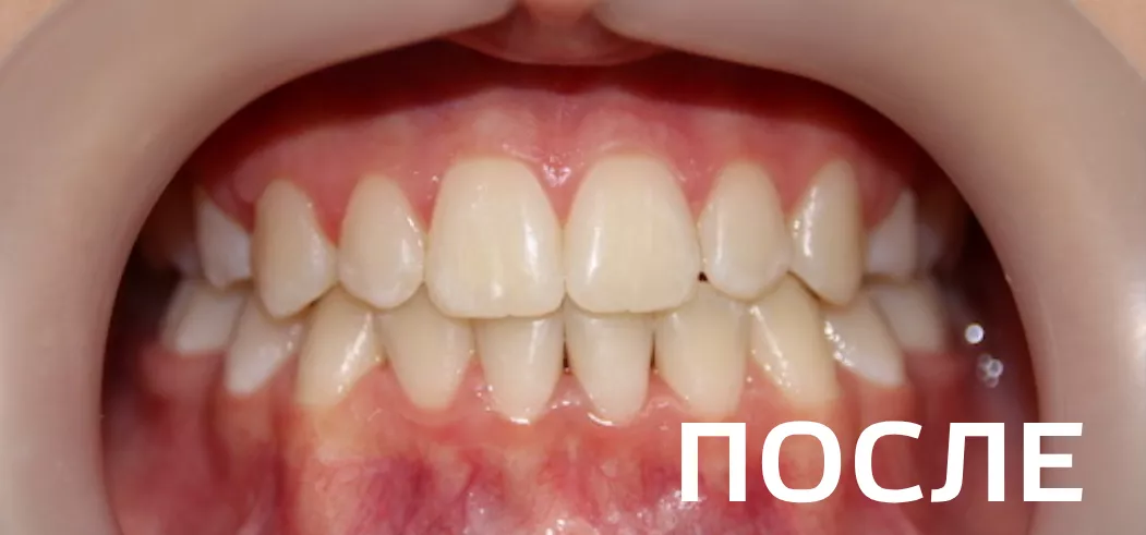 Фото после - Исправление прикуса, выравнивание зубов