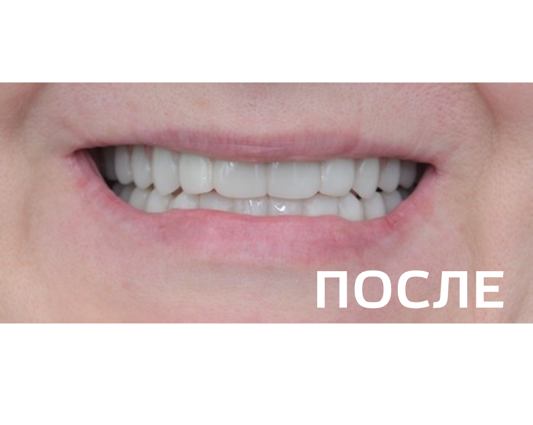 Комплексное восстановление зубных рядов керамическими винирами и коронками  с опорой на зубы и импланты 