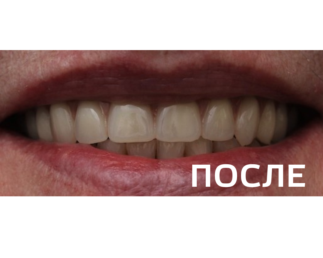 Ортопедическое восстановление зубных рядов верхней и нижней челюстей  