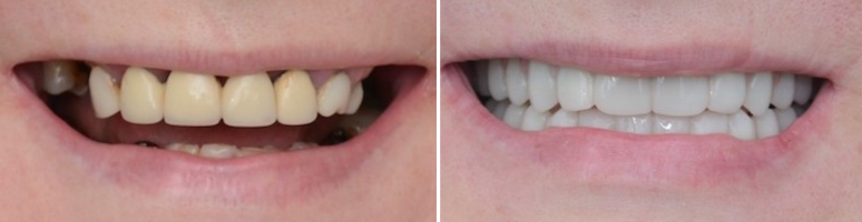 Фото до и после - Лечение зубов под микроскопом