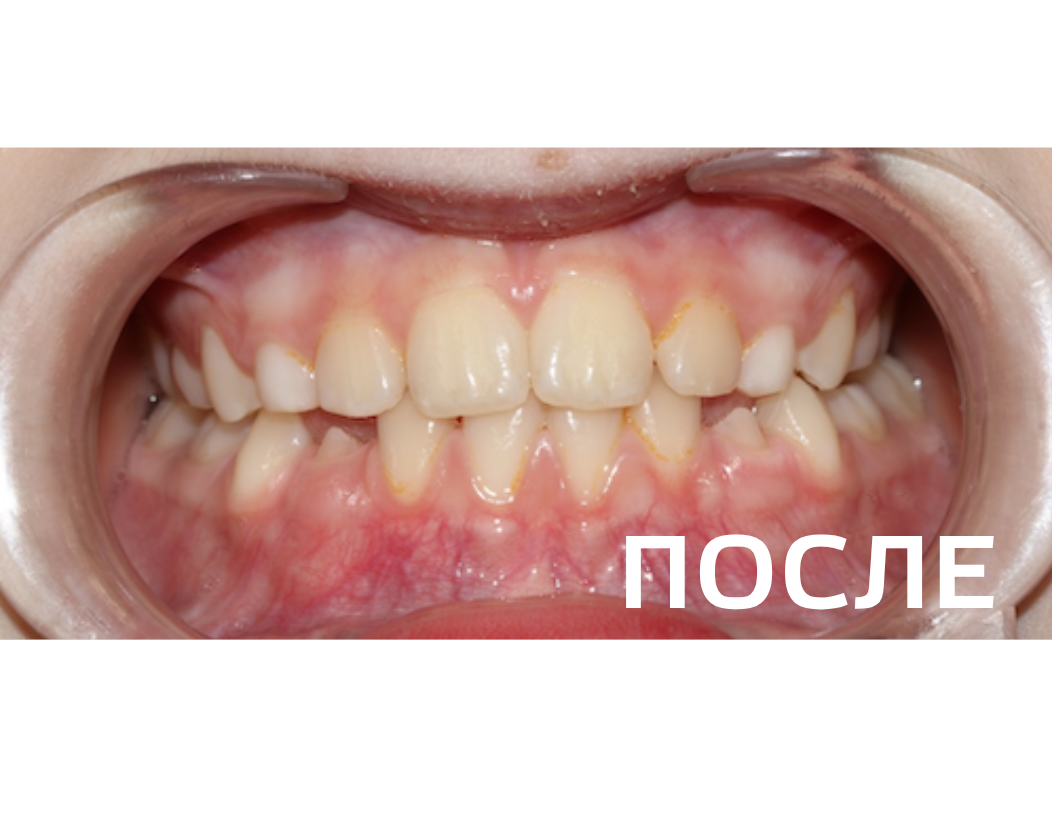 Исправление прикуса, выравнивание зубов