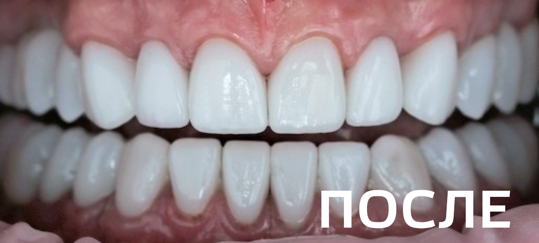 Комплексное ортопедическое восстановление зубных рядов 