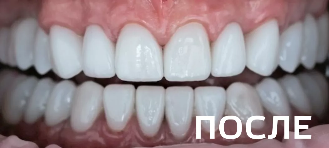 Фото после - Комплексное ортопедическое восстановление зубных рядов 