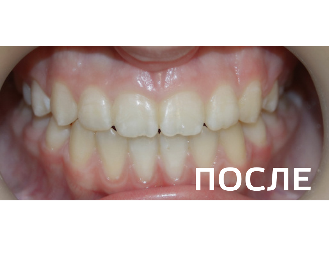 Исправление прикуса, выравнивание зубов