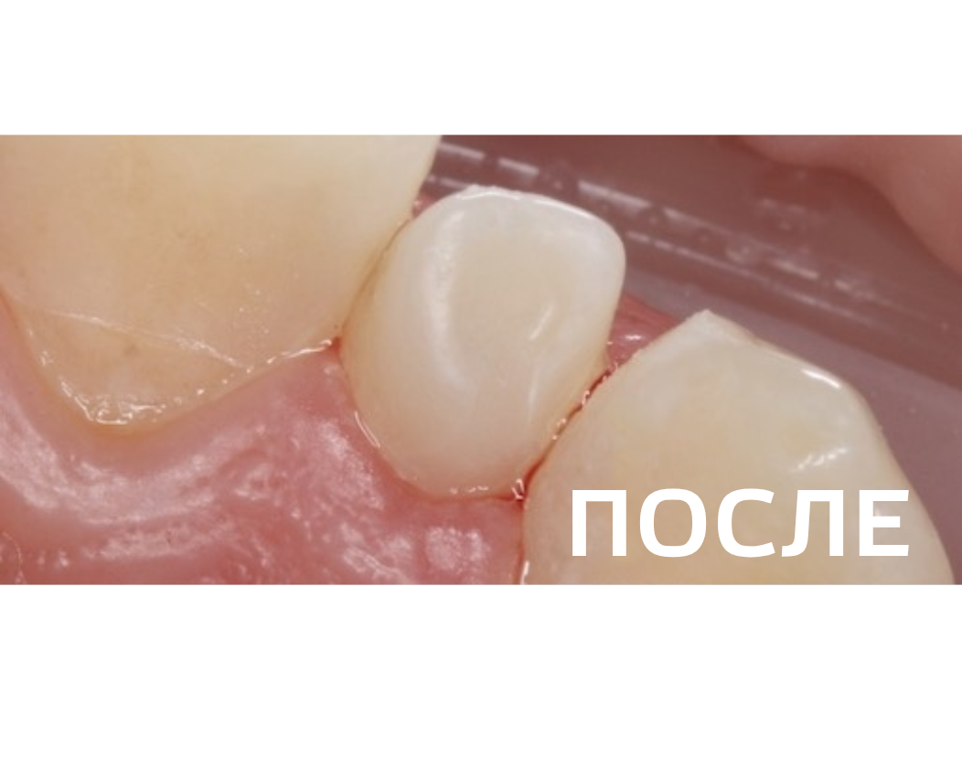 Патология dens invaginatus