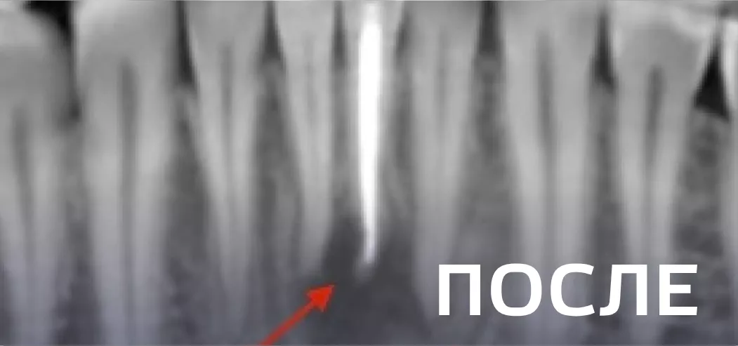 Фото после - Лечение периодонтита