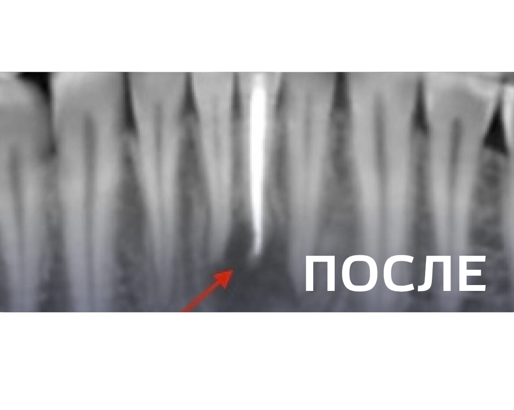 Лечение периодонтита