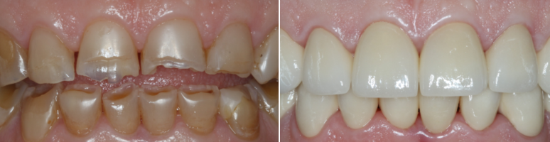 Фото до и после - Прицельный снимок зубов