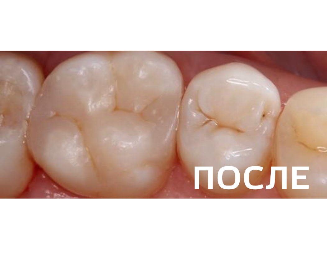 Лечение кариеса