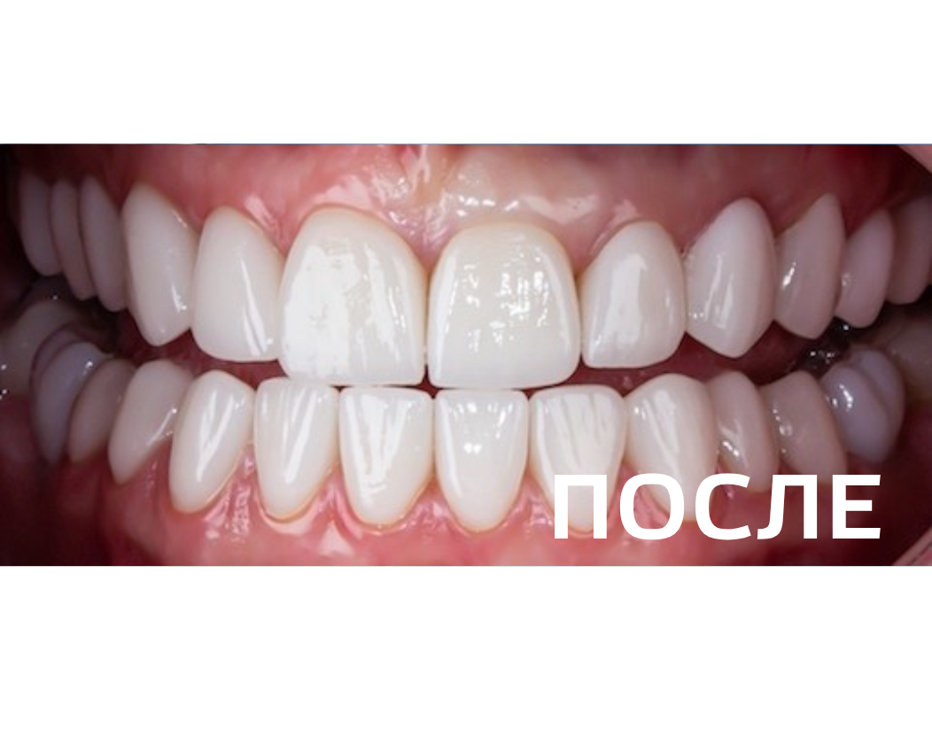 Восстановление эстетики улыбки и функции зубных рядов с помощью керамических коронок E.max