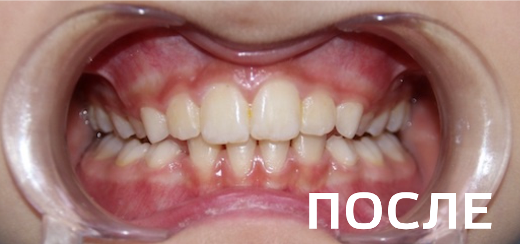 Фото после - Исправление прикуса, выравнивание зубов