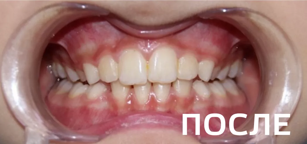 Фото после - Исправление прикуса, выравнивание зубов