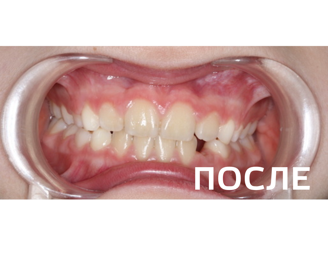 Исправление прикуса, выравнивание зубов