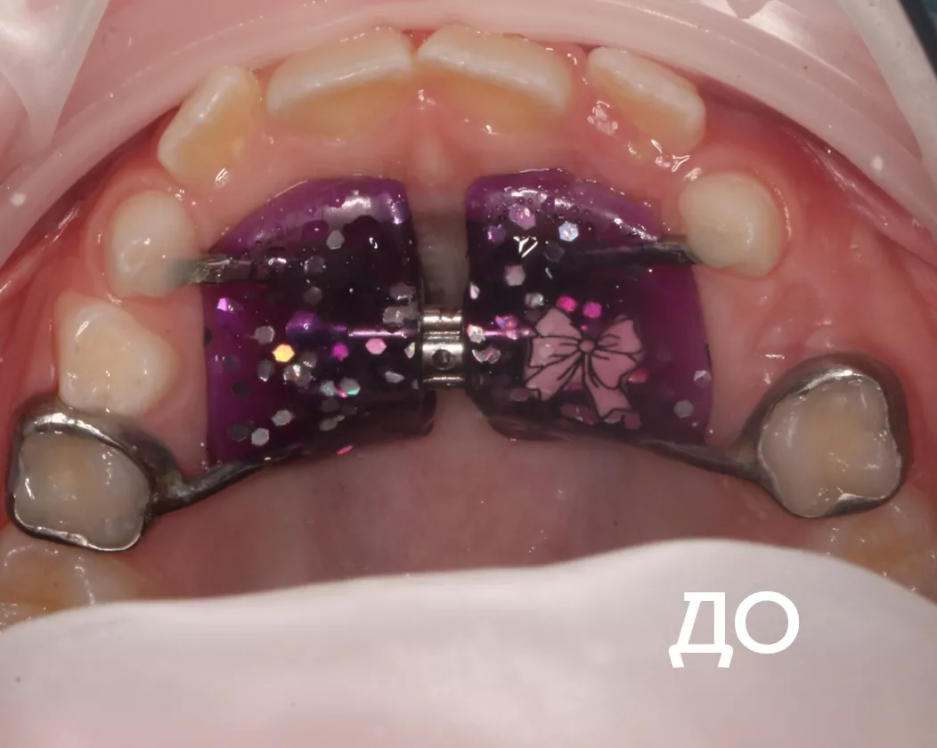 Фото до - Исправление прикуса несъемными аппаратами