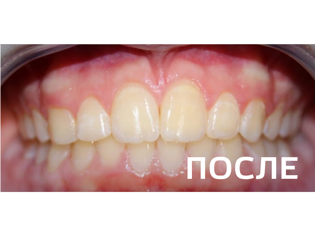 Исправление прикуса, выравнивание зубов