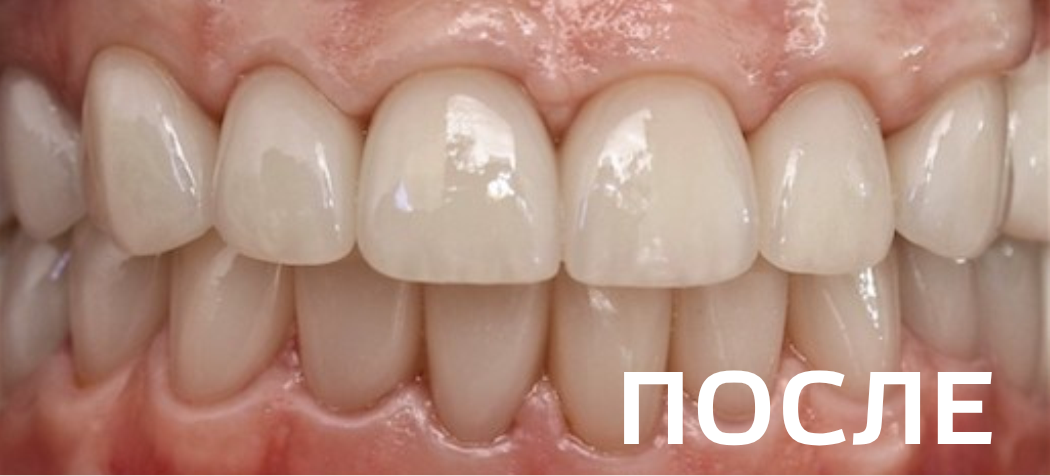 Ортопедическое восстановление зубов по методике All-on-6