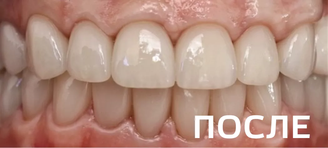 Фото после - Ортопедическое восстановление зубов по методике All-on-6 