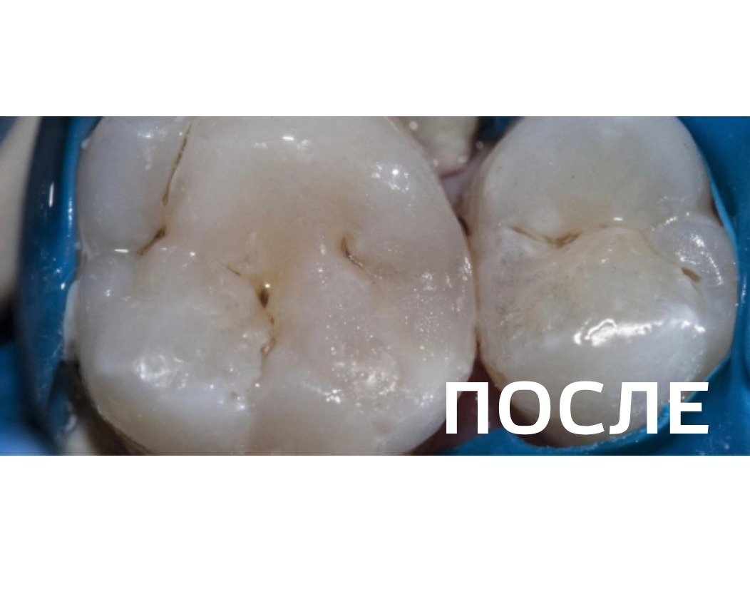 Лечение контактного кариеса