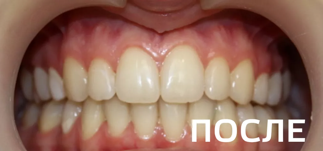 Фото после - Исправление прикуса, выравнивание зубов