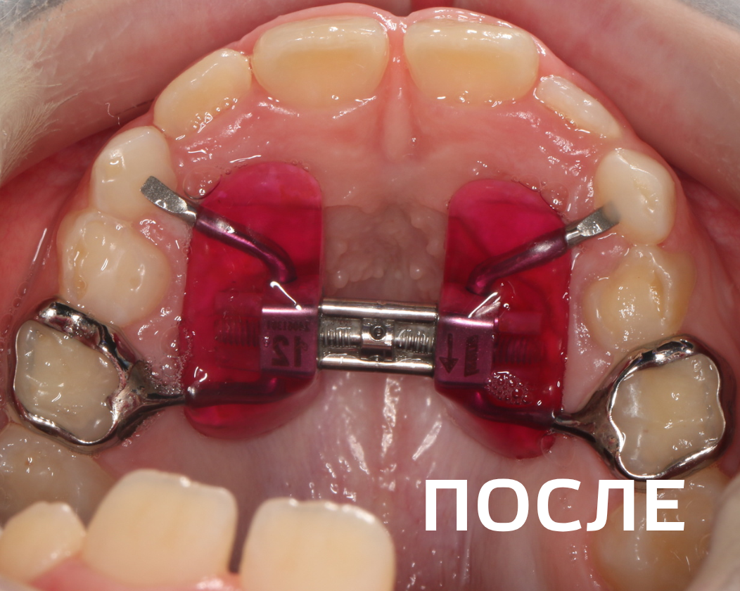 Фото до и после - Керамические брекеты