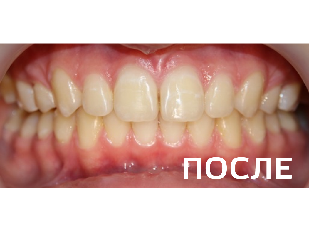 Исправление прикуса, выравнивание зубов