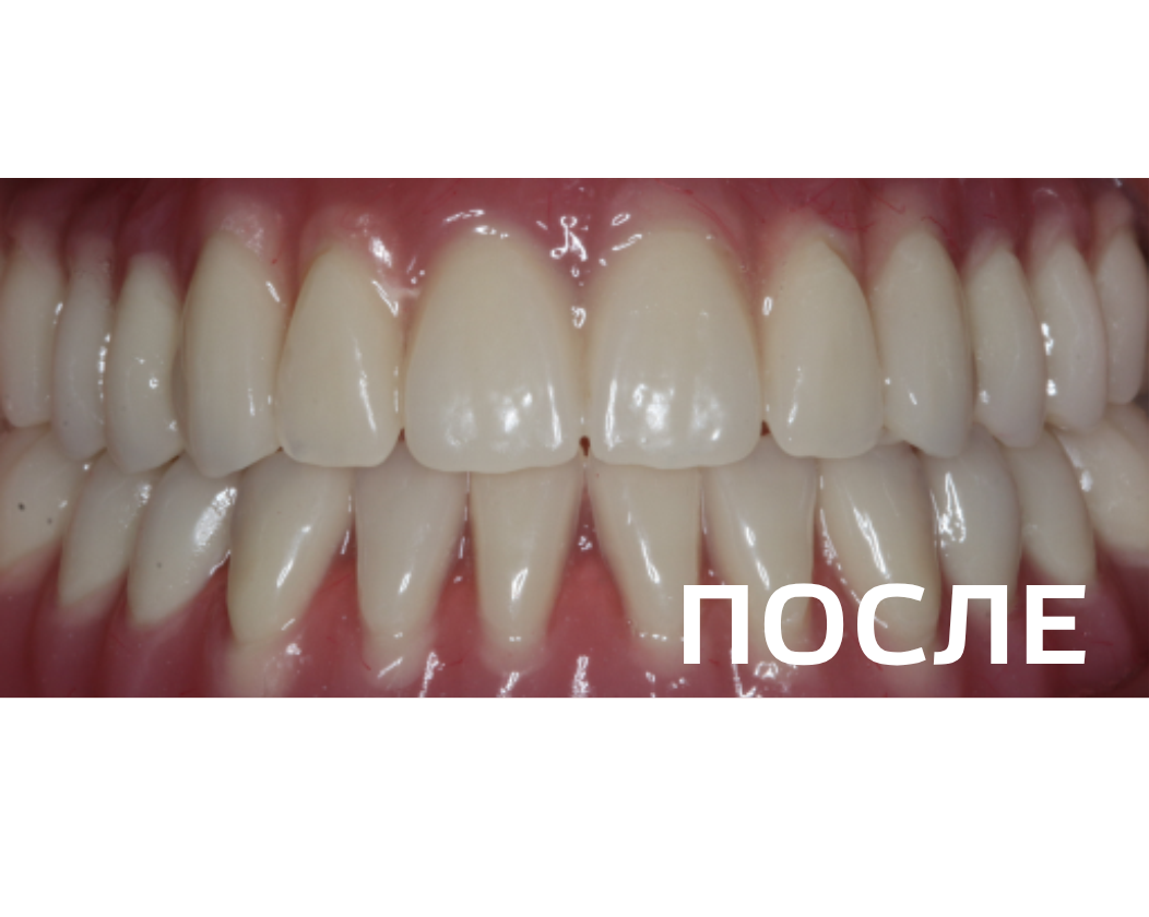 Восстановление зубного ряда полным съемным протезом