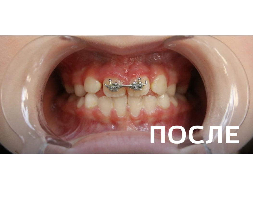 Исправление прикуса, выравнивание зубов