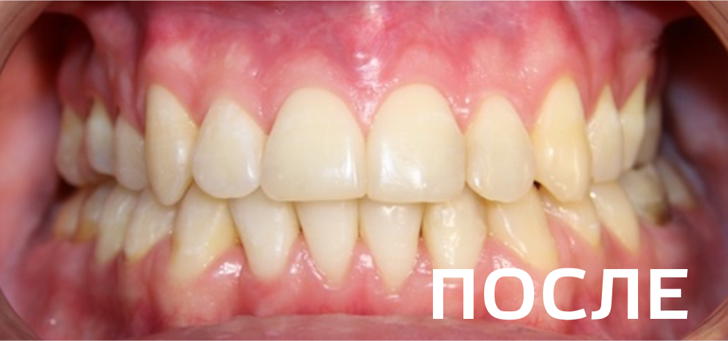 Фото после - Исправление прикуса, выравнивание зубов