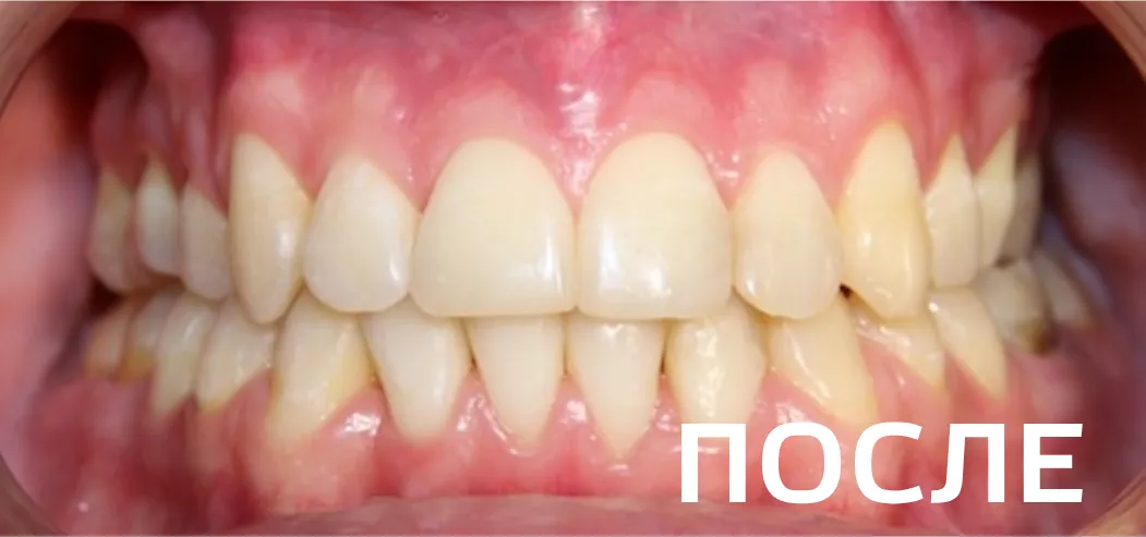 Фото после - Исправление прикуса, выравнивание зубов