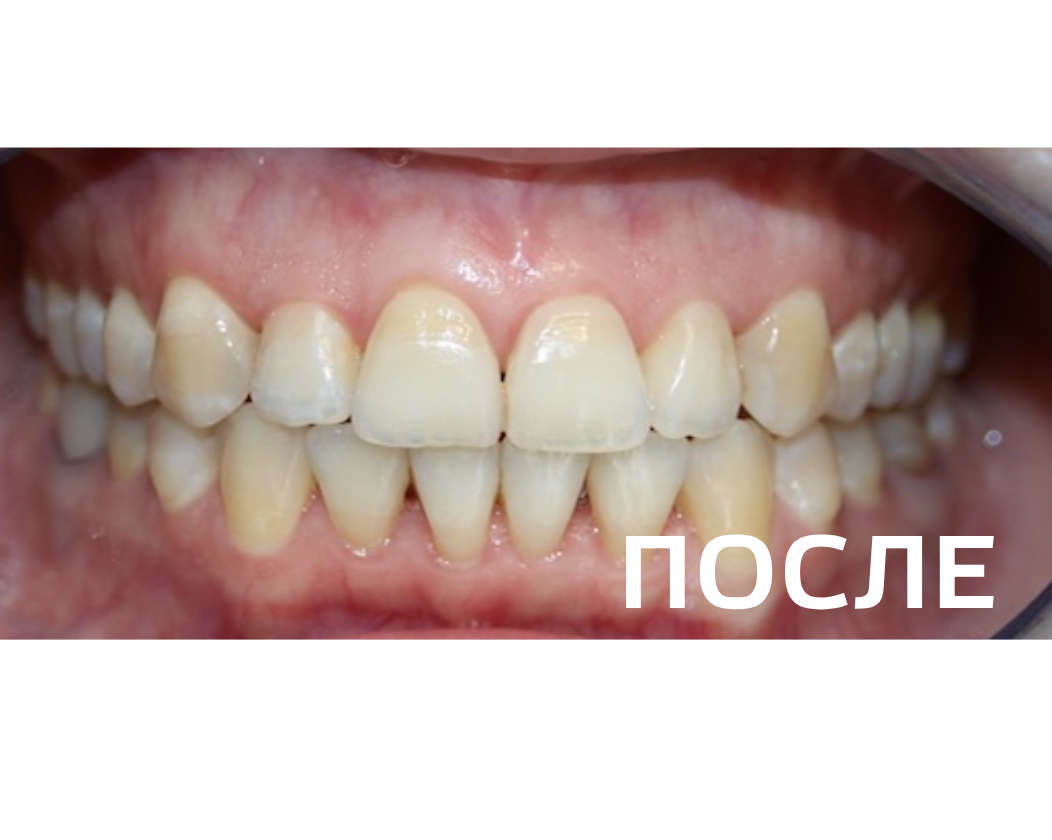 Исправление прикуса, выравнивание зубов
