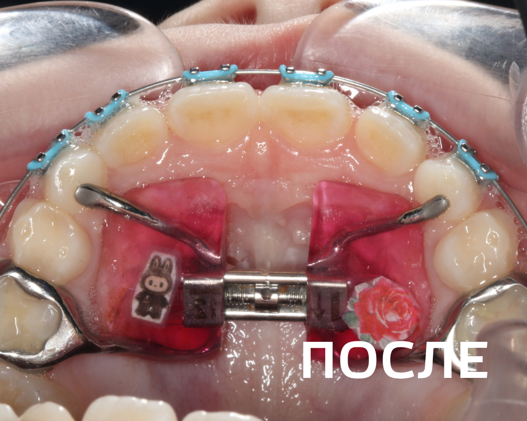 Исправление прикуса несъемными аппаратами и брекет-системой