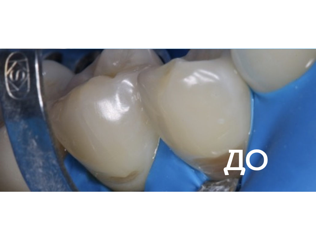  Лечение клиновидных дефектов
