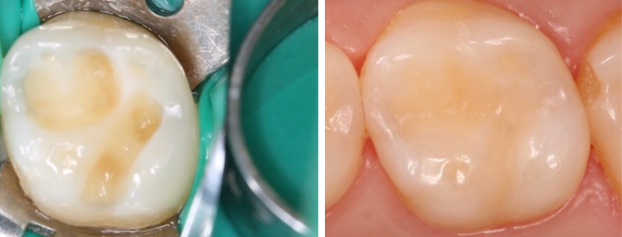 Фото до и после - Лечение кариеса дентина