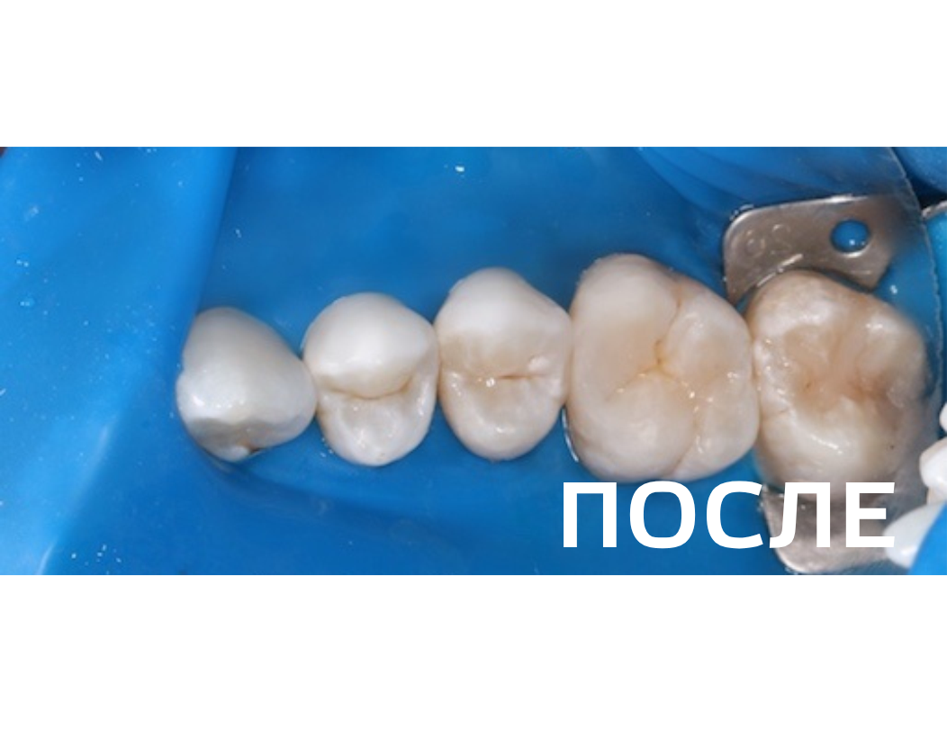 Лечение кариеса