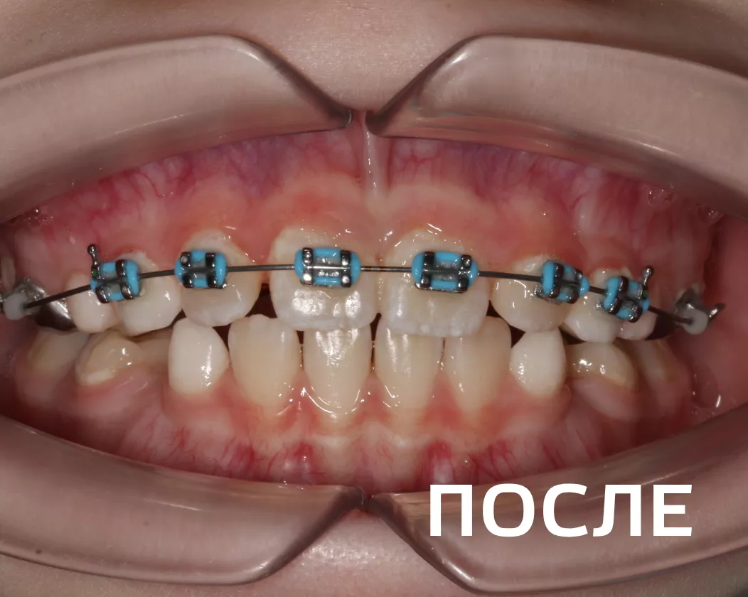 Фото после - Исправление прикуса несъемными аппаратами и брекет-системой