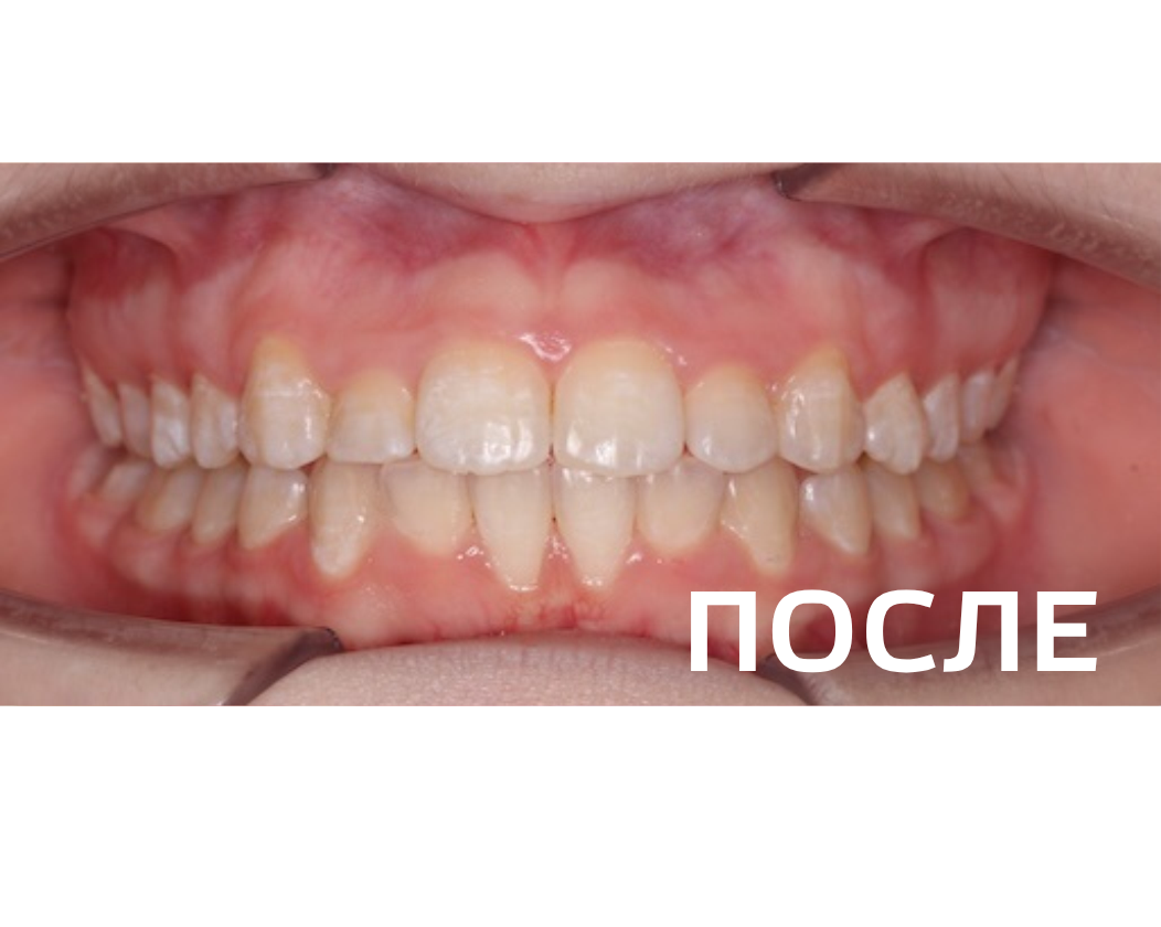 Исправление прикуса, выравнивание зубов