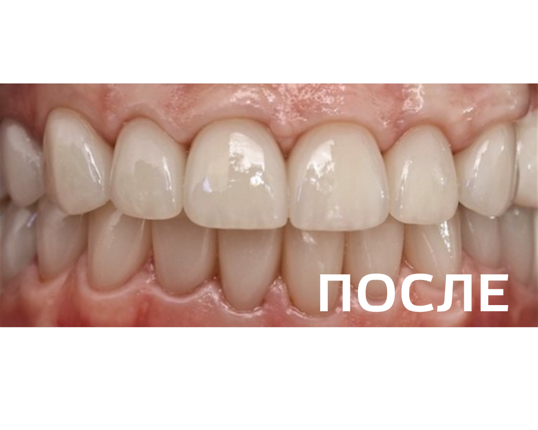 Ортопедическое восстановление зубов по методике All-on-6 