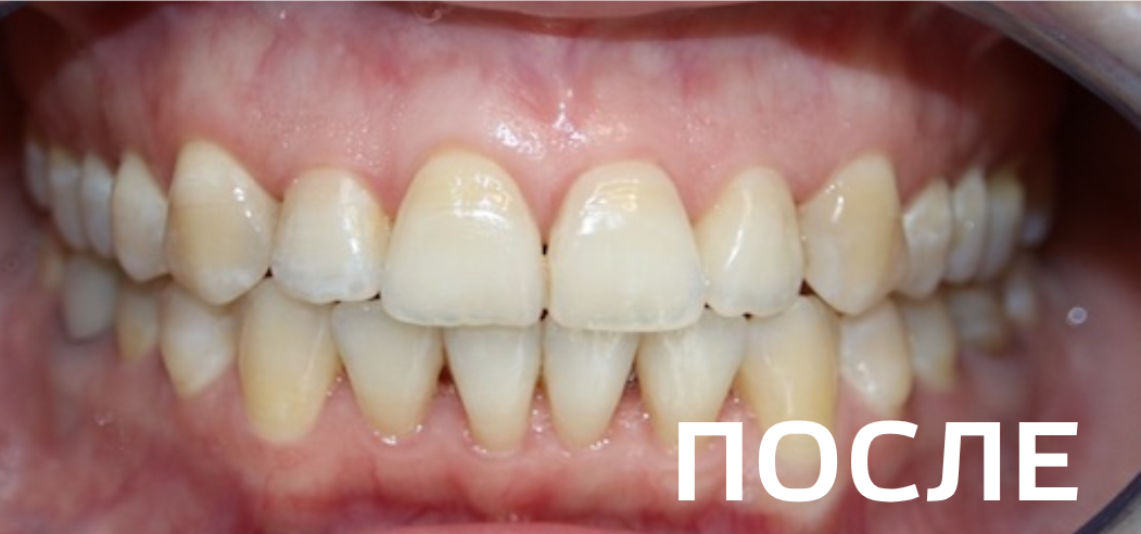 Фото после - Исправление прикуса, выравнивание зубов