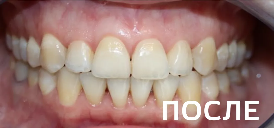 Фото после - Исправление прикуса, выравнивание зубов