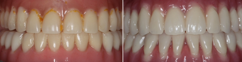 Фото до и после - Коронки на молочные зубы